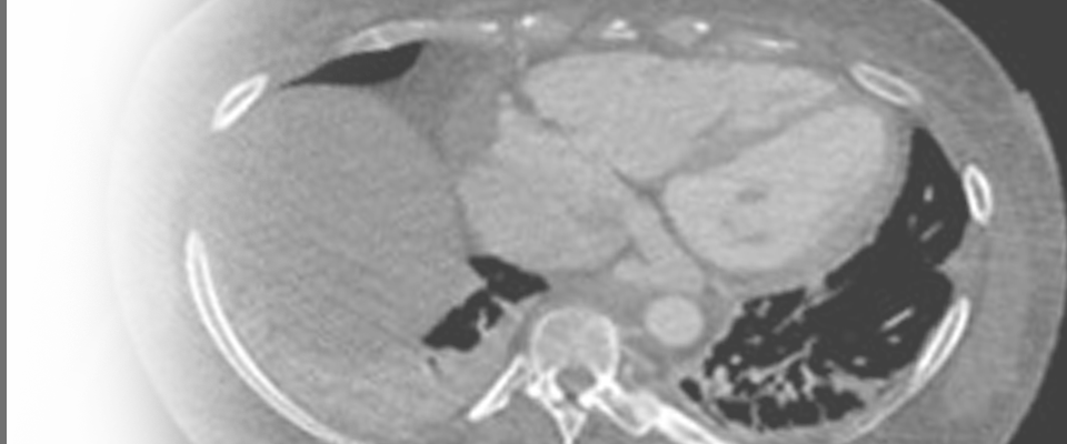 Axial CT Slice of the Heart